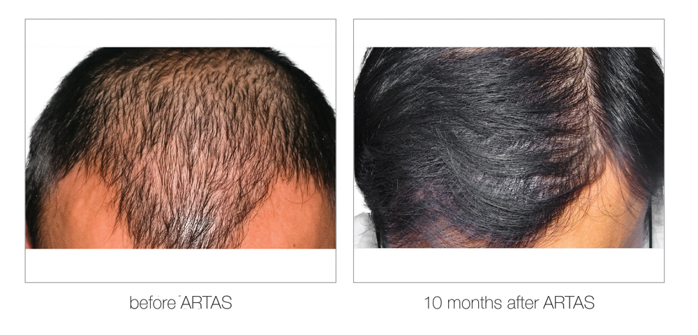 ARTAS-Before-and-After_0000_Layer 14