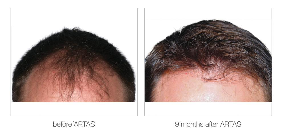 ARTAS-Before-and-After_0001_Layer 13