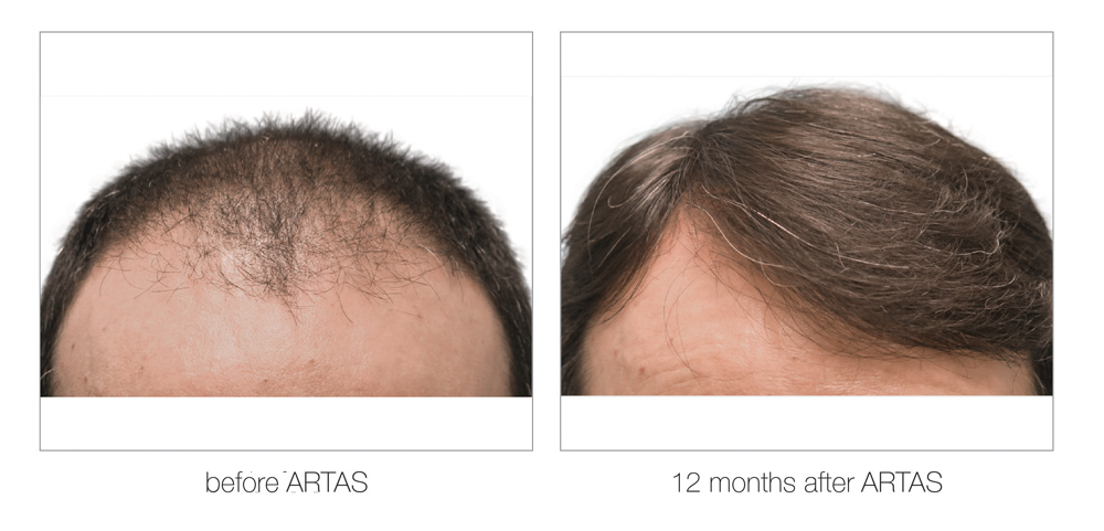 ARTAS-Before-and-After_0002_Layer 12