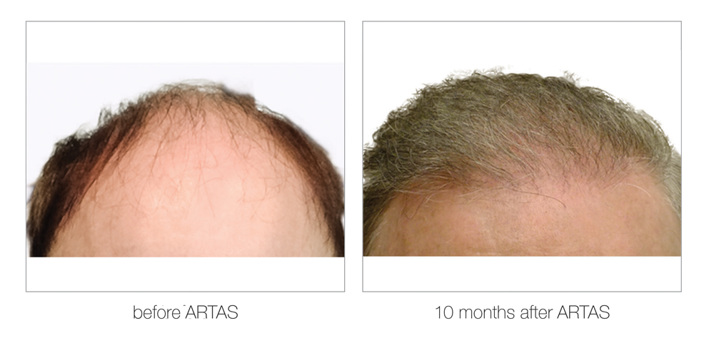 ARTAS-Before-and-After_0003_Layer 11