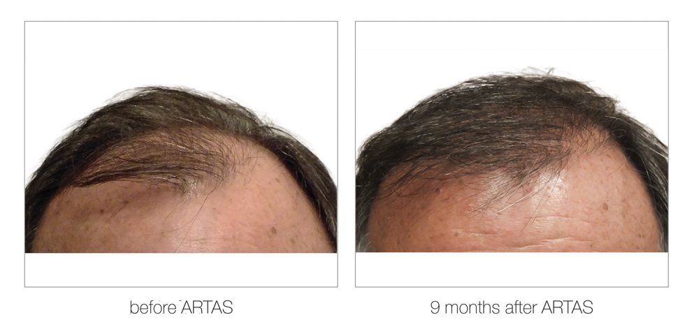 ARTAS-Before-and-After_0004_Layer 10