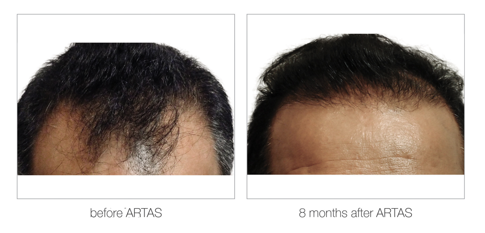 ARTAS-Before-and-After_0005_Layer 9