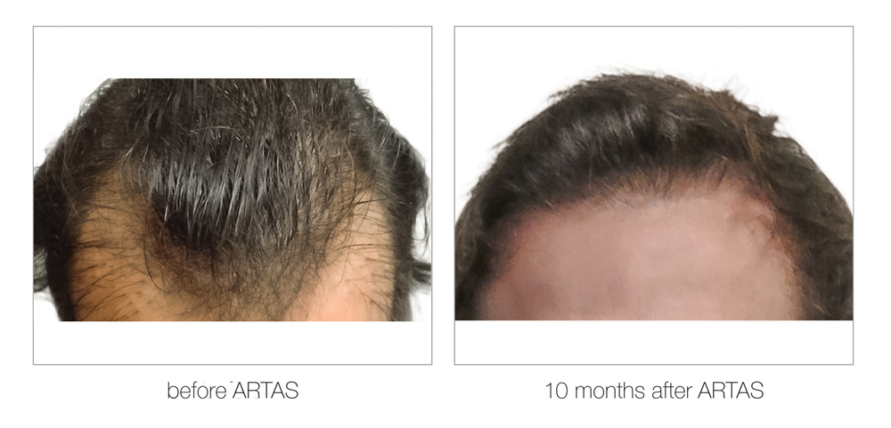 ARTAS-Before-and-After_0006_Layer 8