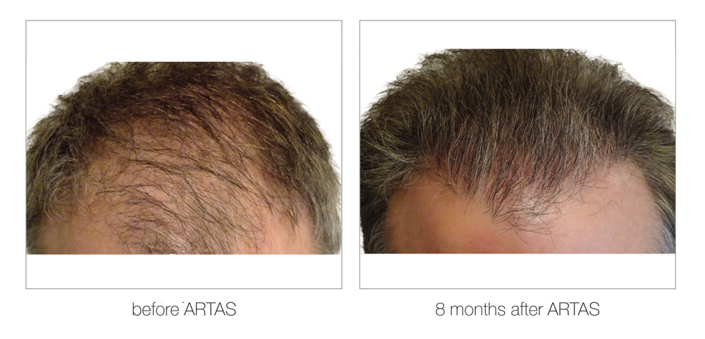 ARTAS-Before-and-After_0007_Layer 7