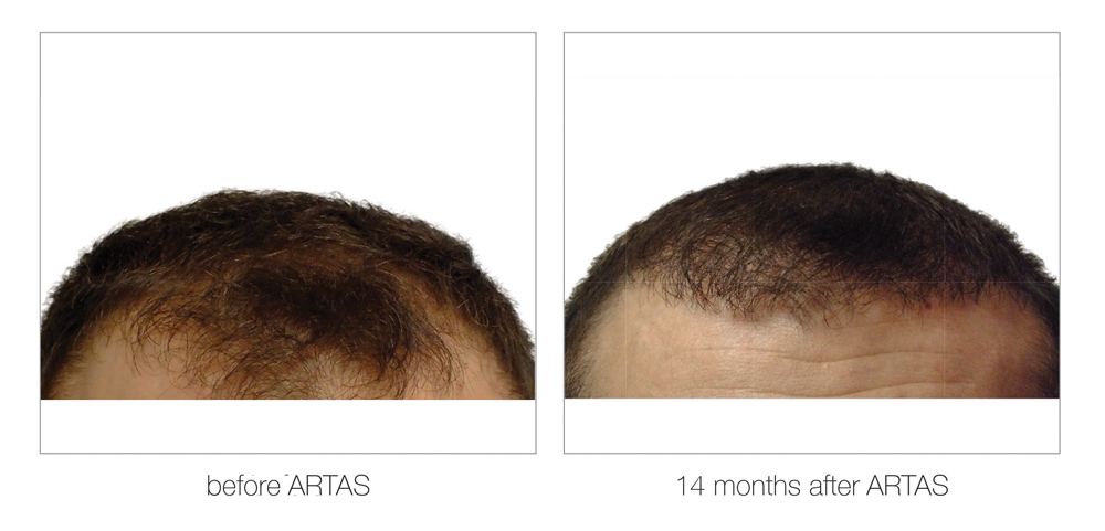 ARTAS-Before-and-After_0008_Layer 6