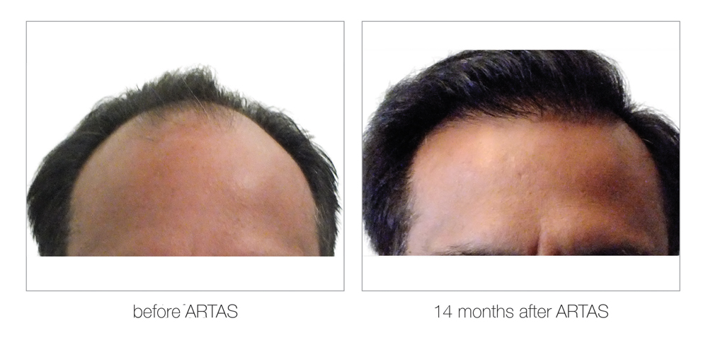 ARTAS-Before-and-After_0009_Layer 5