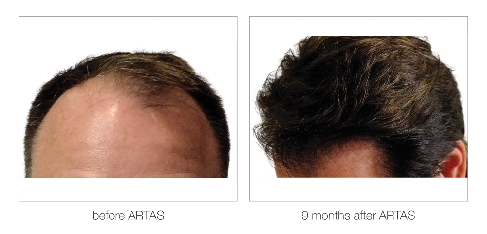 ARTAS-Before-and-After_0010_Layer 4