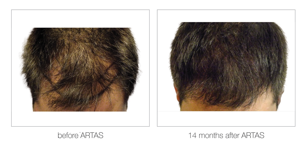 ARTAS-Before-and-After_0011_Layer 3