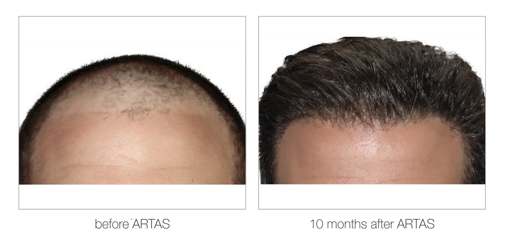 ARTAS-Before-and-After_0012_Layer 2