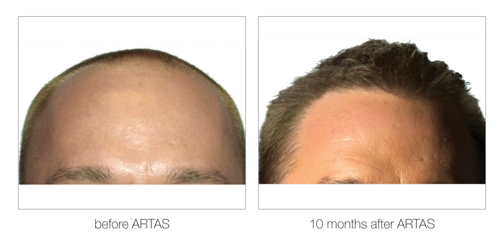 ARTAS-Before-and-After_0013_Layer 1